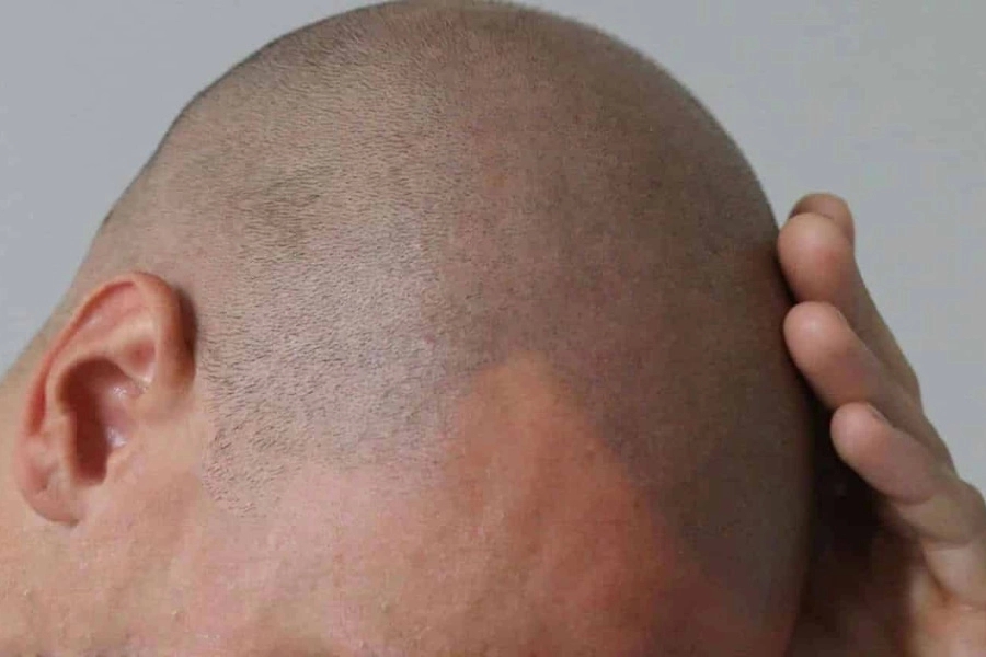 Hair Loss: What You Should Know About the Different Causes and Treatments